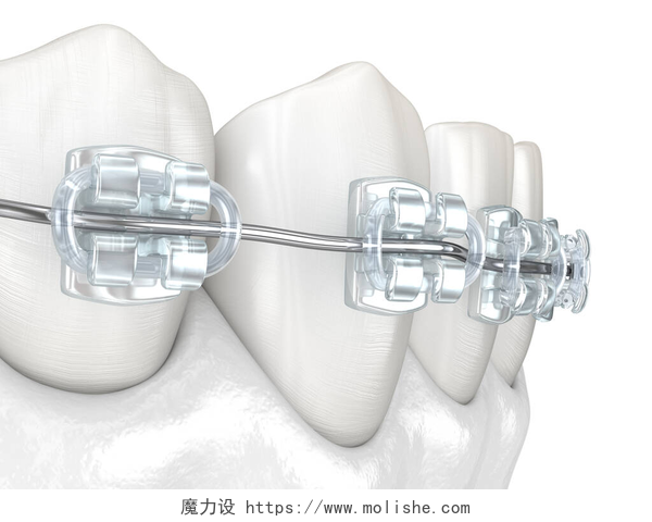 牙齿矫正特写牙齿和清晰的支撑。医学上准确的牙科3D图像